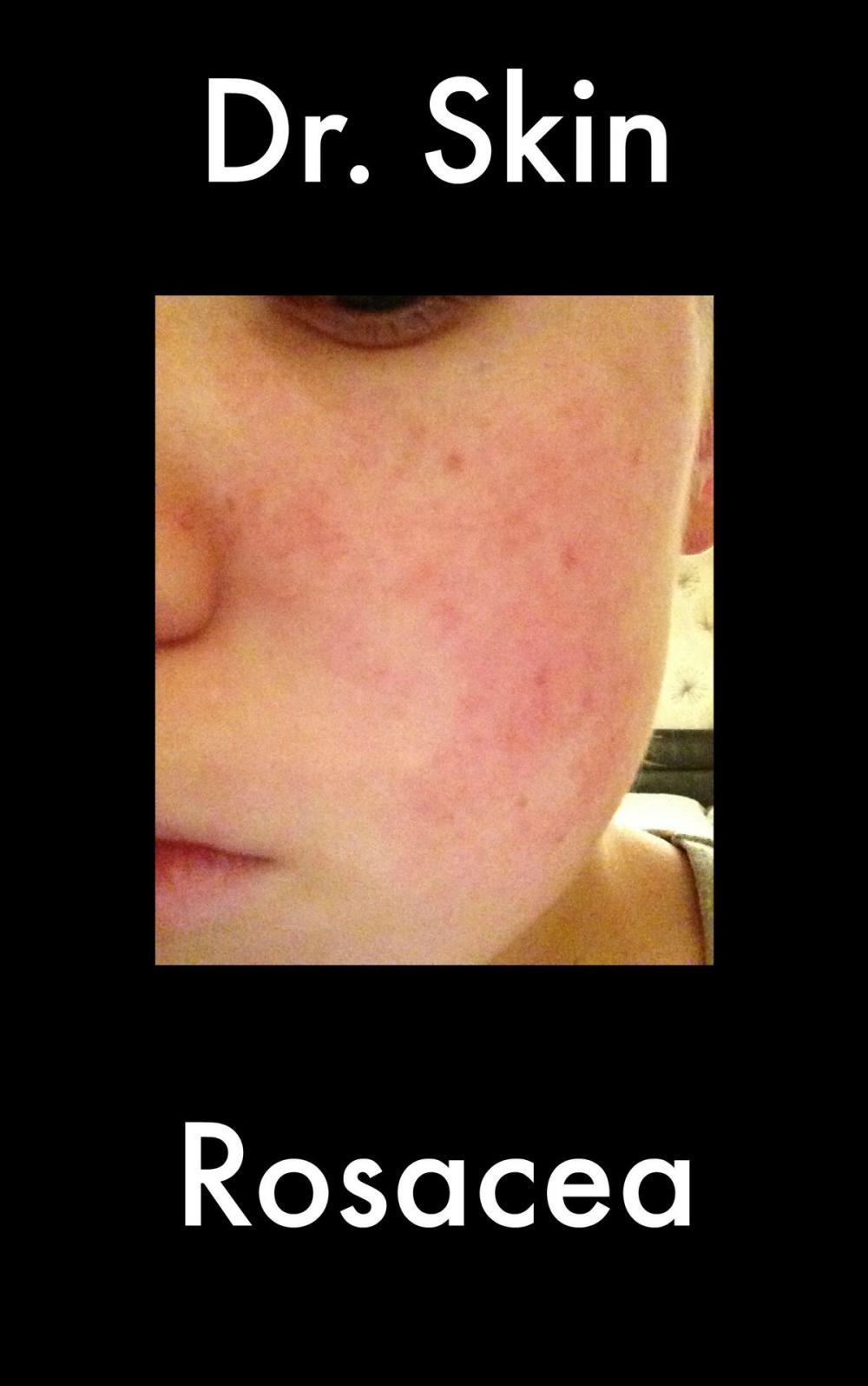 Big bigCover of Rosacea