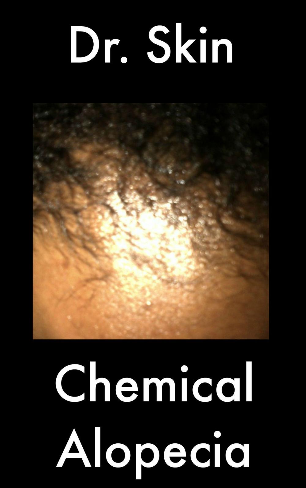 Big bigCover of Chemical Alopecia