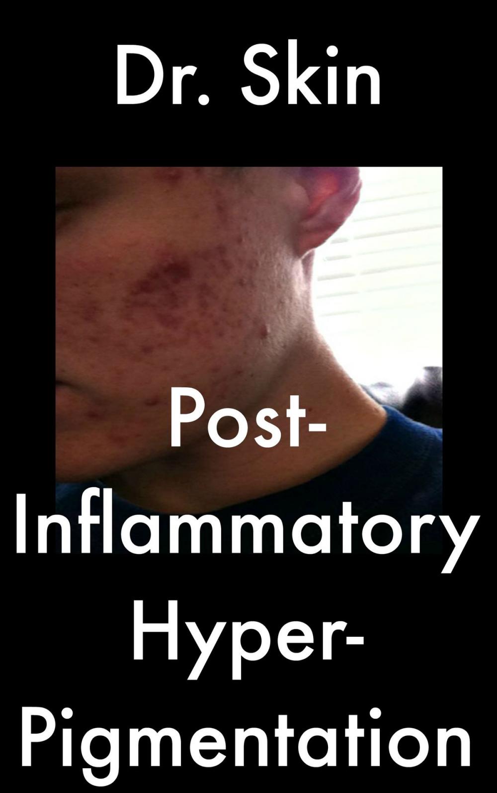Big bigCover of Post Inflammatory Hyperpigmentation