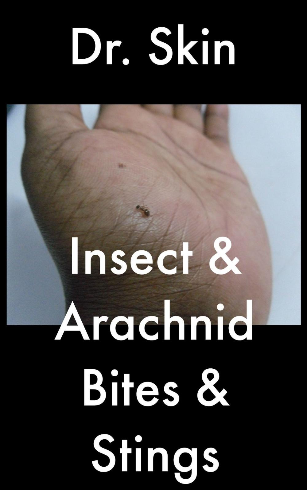 Big bigCover of Insect and Arachnid Bites and Stings