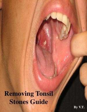 Cover of the book Removing Tonsil Stones Guide by V.T.