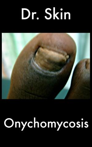 Cover of the book Onychomycosis by Dr Skin
