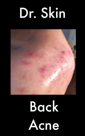 bigCover of the book Back Acne by 