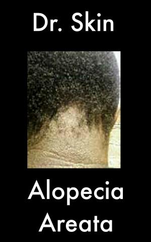 Book cover of Alopecia Areata