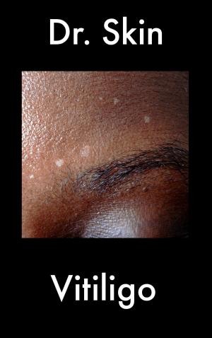 Book cover of Vitiligo