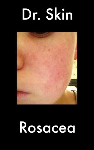 bigCover of the book Rosacea by 