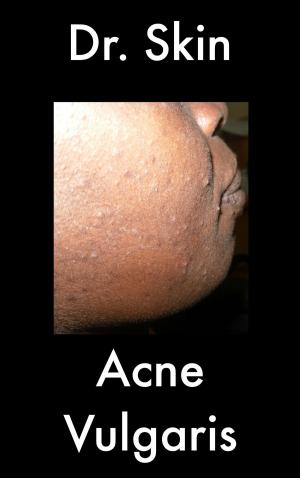 bigCover of the book Acne Vulgaris by 