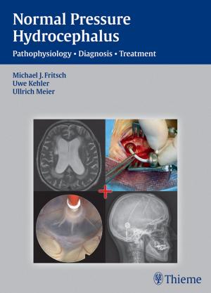 bigCover of the book NPH - Normal Pressure Hydrocephalus by 
