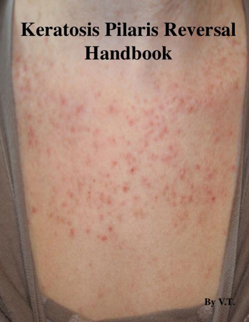 Cover of the book Keratosis Pilaris Reversal Handbook by V.T., V.T.