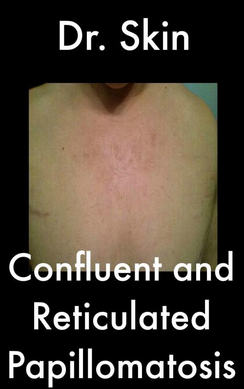 Cover of the book Confluent and Reticulated Papillomatosis by Dr Skin, Dr Skin