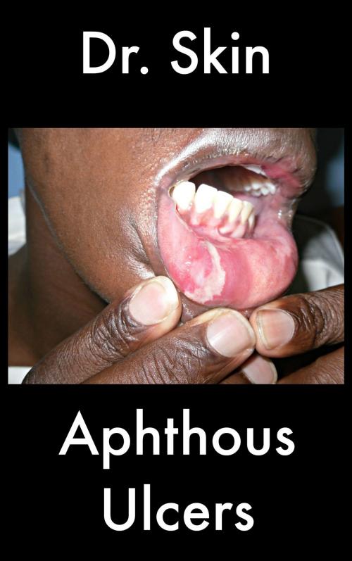 Cover of the book Aphthous Ulcers by Dr Skin, Dr Skin