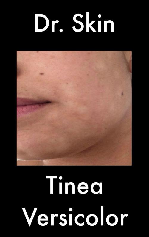 Cover of the book Tinea Versicolor by Dr Skin, Dr Skin
