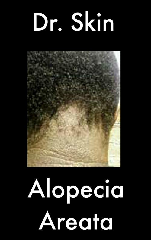 Cover of the book Alopecia Areata by Dr Skin, Dr Skin