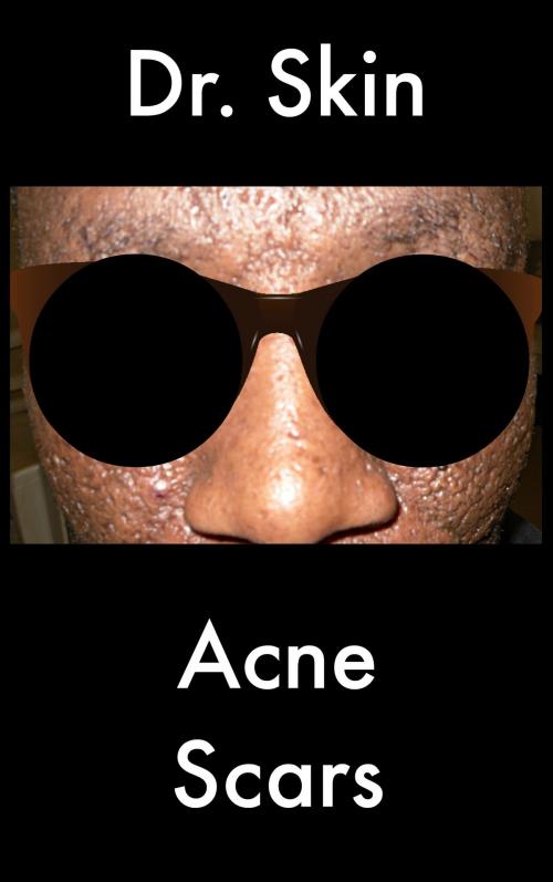 Cover of the book Acne Scars by Dr Skin, Dr Skin