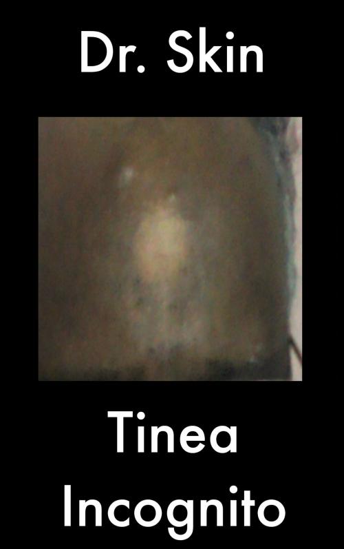 Cover of the book Tinea Incognito by Dr Skin, Dr Skin
