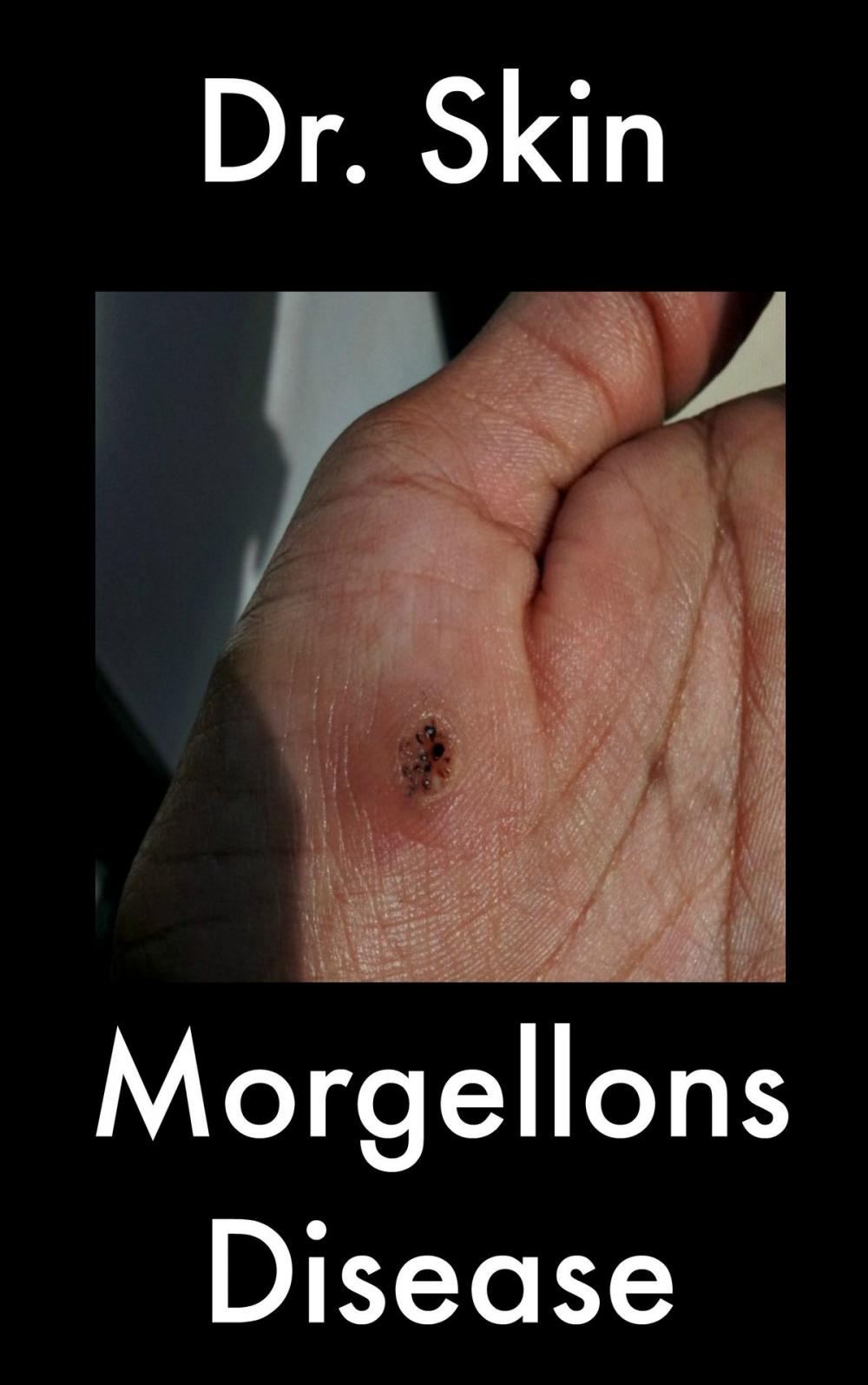Big bigCover of Morgellons Disease