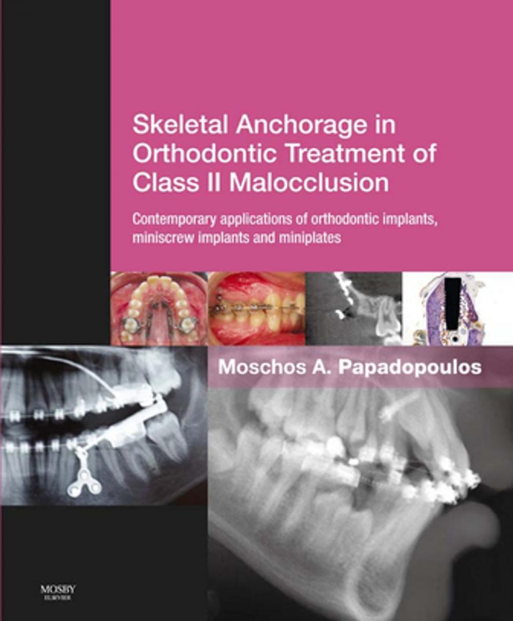 Big bigCover of Skeletal Anchorage in Orthodontic Treatment of Class II Malocclusion E-Book