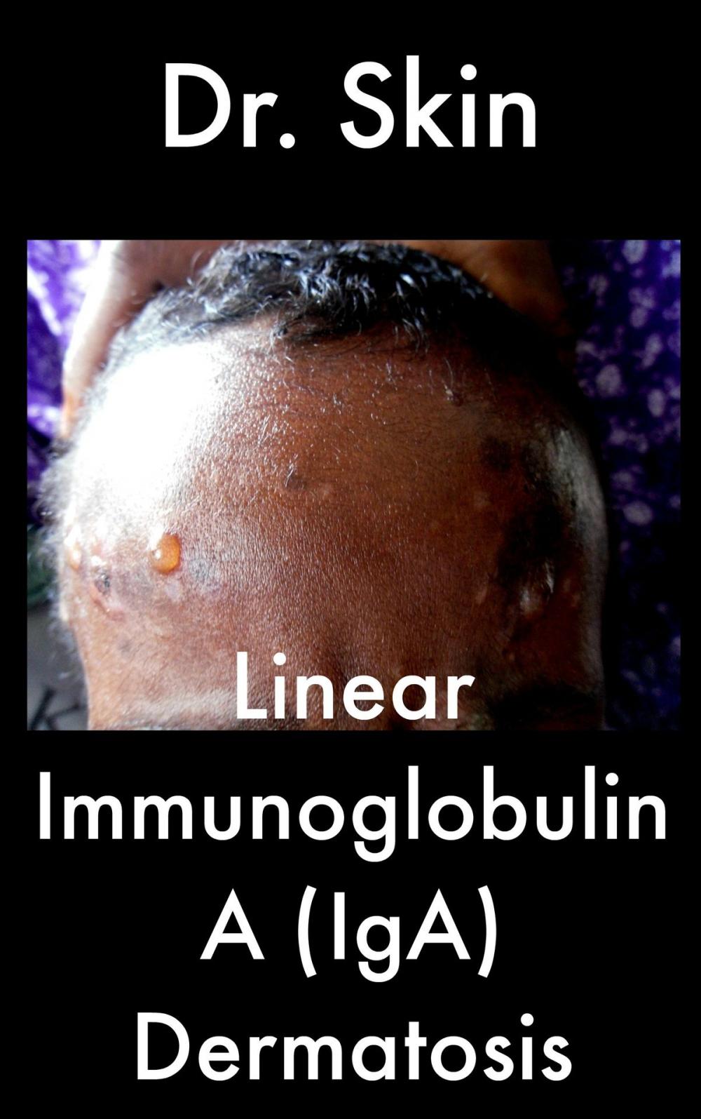 Big bigCover of Linear Immunoglobulin A Dermatosis