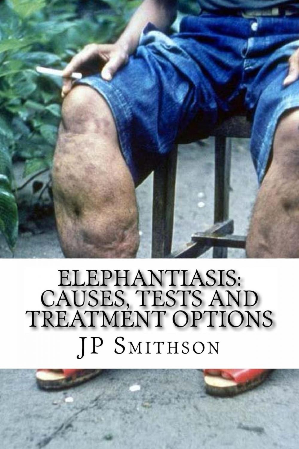 Big bigCover of Elephantiasis: Causes, Tests and Treatment Options