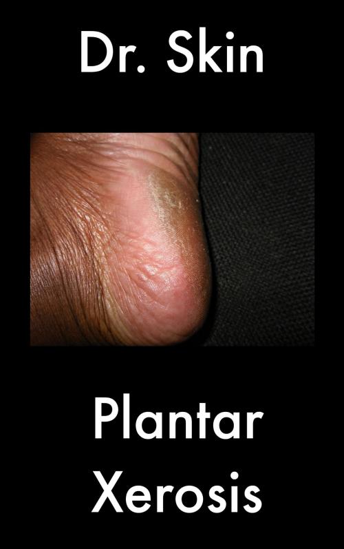 Cover of the book Plantar Xerosis by Dr Skin, Dr Skin