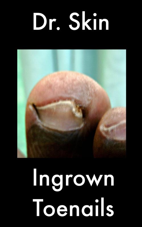 Cover of the book Ingrown Toenails by Dr Skin, Dr Skin