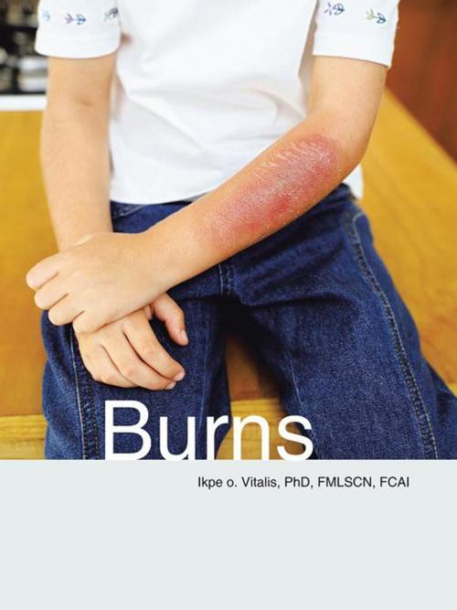Cover of the book Burns by Ikpe O. Vitalis PhD FMLSCN FCAI, Partridge Publishing Africa