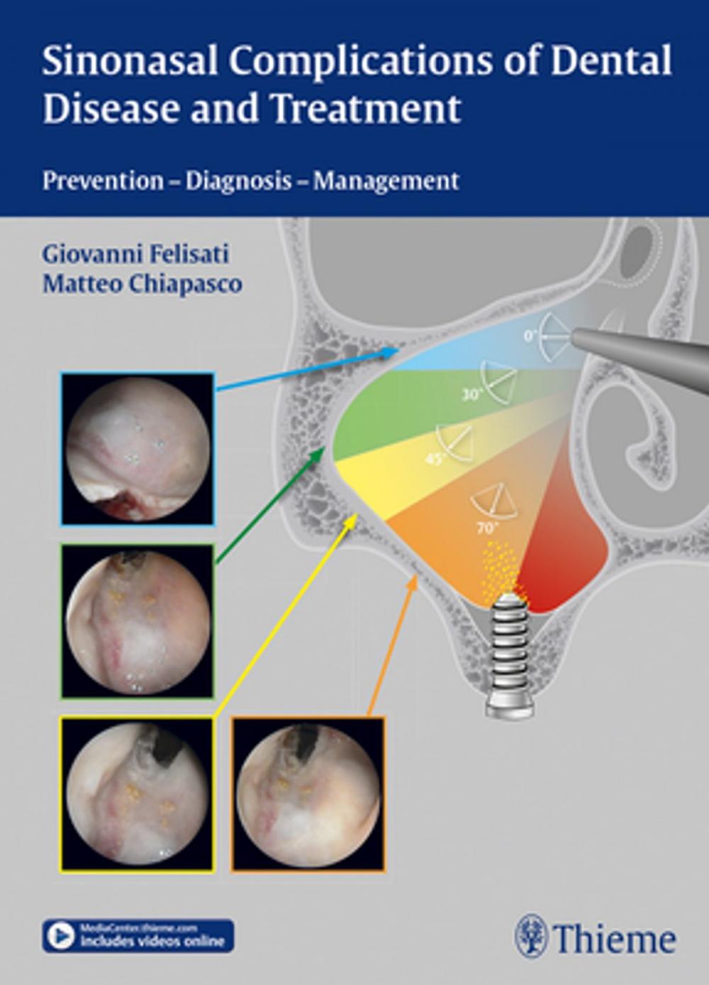 Big bigCover of Sinonasal Complications of Dental Disease and Treatment
