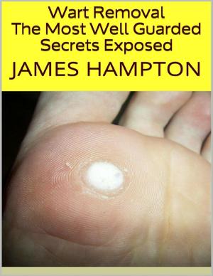 Cover of the book Wart Removal: The Most Well Guarded Secrets Exposed by Ian Josephs