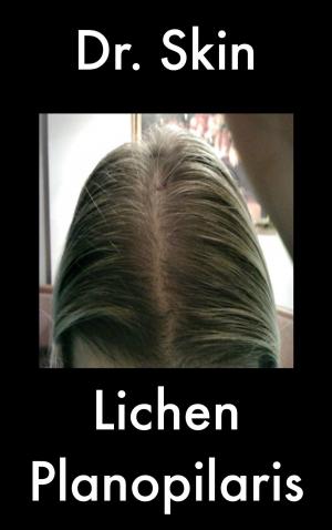 Book cover of Lichen Planopilaris