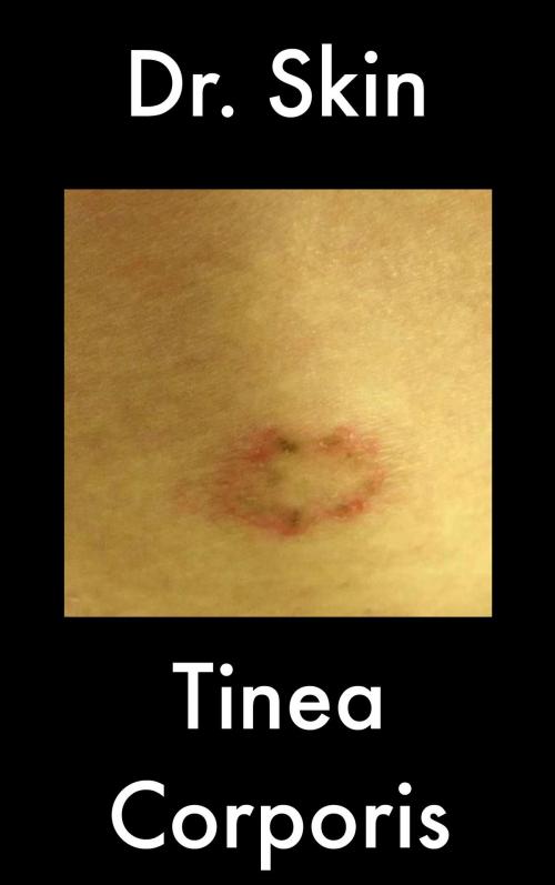 Cover of the book Tinea Corporis by Dr Skin, Dr Skin