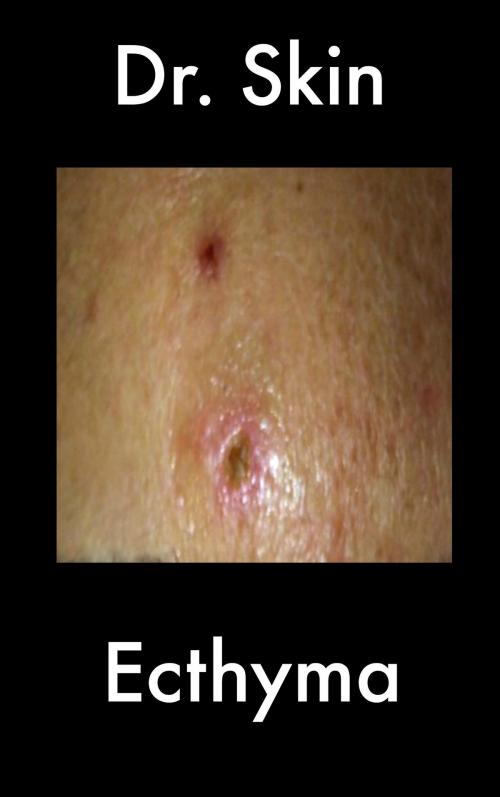 Cover of the book Ecthyma by Dr Skin, Dr Skin