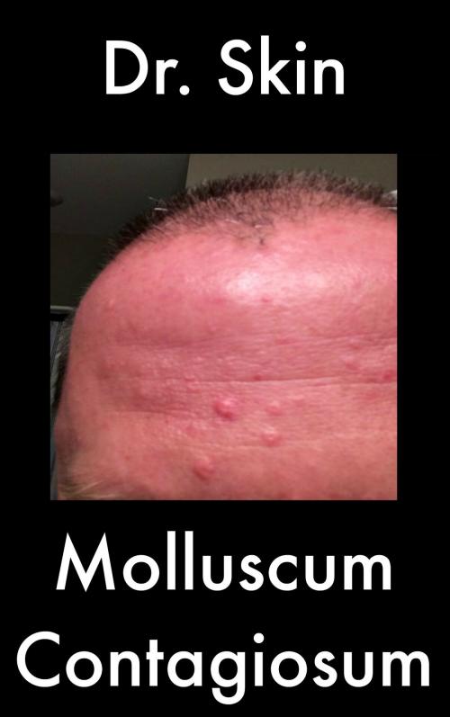 Cover of the book Molluscum Contagiosum by Dr Skin, Dr Skin