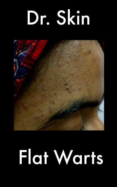 Cover of the book Flat Warts by Dr Skin, Dr Skin