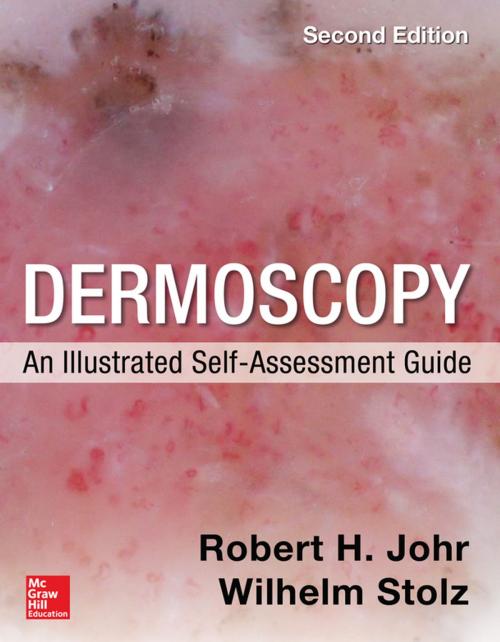 Cover of the book Dermoscopy: An Illustrated Self-Assessment Guide by Robert Johr, Wilhelm Stolz, McGraw-Hill Education