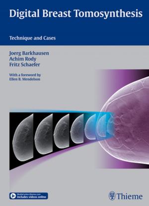 Cover of the book Digital Breast Tomosynthesis by Hans Gombotz, Kai Zacharowski, Donat Rudolf Spahn