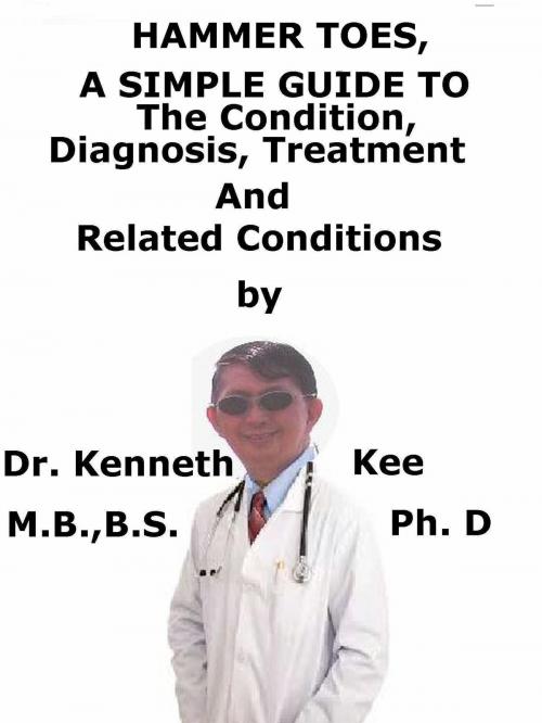 Cover of the book Hammer Toes, A Simple Guide To The Condition, Diagnosis, Treatment And Related Conditions by Kenneth Kee, Kenneth Kee