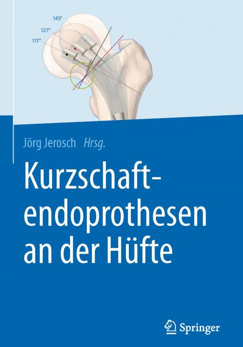 Cover of the book Kurzschaftendoprothesen an der Hüfte by , Springer Berlin Heidelberg