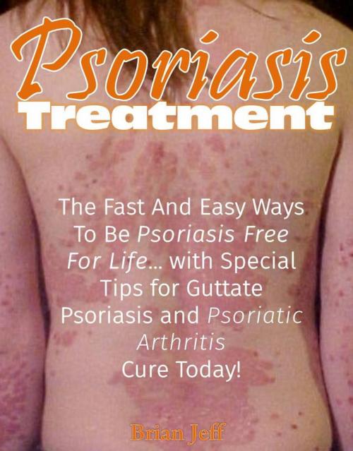 Cover of the book Psoriasis Treatment: The Fast and Easy Ways to Be Psoriasis Free for Life... with Special Tips for Guttate Psoriasis and Psoriatic Arthritis Cure Today! by Brian Jeff, Eljays-epublishing
