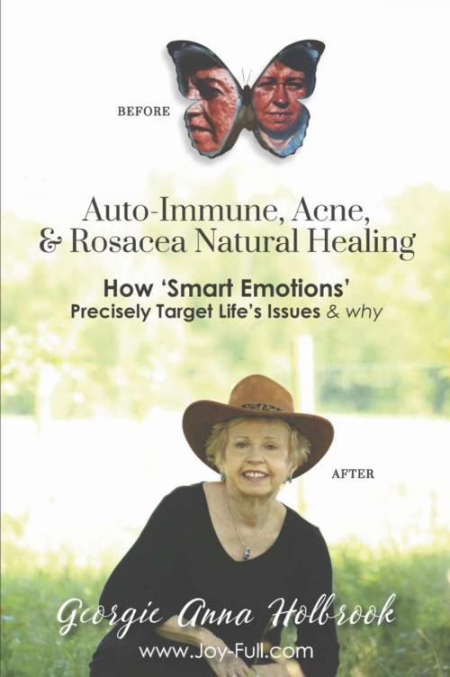 Cover of the book Auto-Immune, Acne, & Rosacea Natural Healing - How 'Smart Emotions' Precisely Target Life's Issues & Why by Georgie Anna Holbrook, BookLocker.com, Inc.