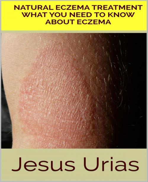 Cover of the book Natural Eczema Treatment by Jesus Urias, BookRix