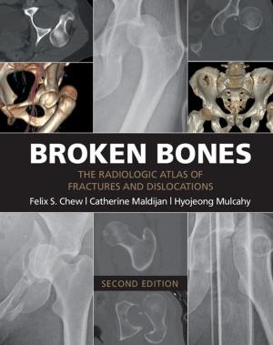 Book cover of Broken Bones