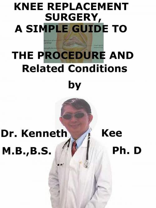 Cover of the book Knee Replacement Surgery, A Simple Guide To The Procedure And Related Conditions by Kenneth Kee, Kenneth Kee