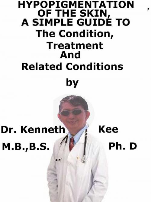 Cover of the book Hypo-Pigmentation Of The Skin A Simple Guide To The Condition, Treatment And Related Conditions by Kenneth Kee, Kenneth Kee