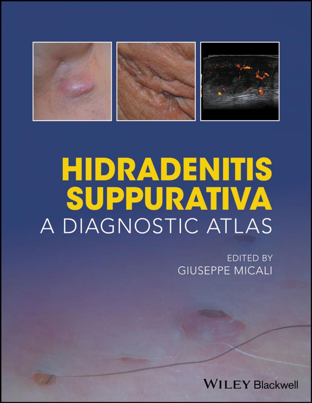Big bigCover of Hidradenitis Suppurativa
