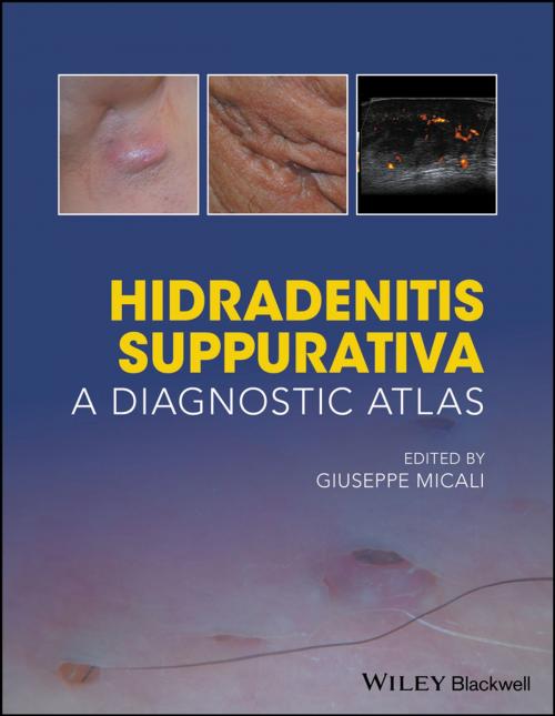 Cover of the book Hidradenitis Suppurativa by , Wiley