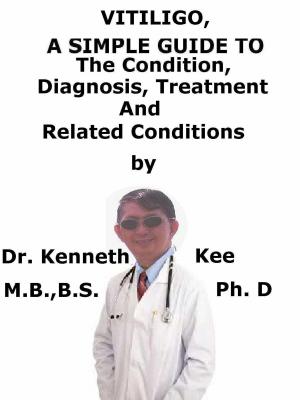 Cover of the book Vitiligo, A Simple Guide To The Condition, Diagnosis, Treatment And Related Conditions by Kenneth Kee