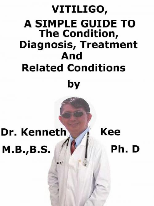 Cover of the book Vitiligo, A Simple Guide To The Condition, Diagnosis, Treatment And Related Conditions by Kenneth Kee, Kenneth Kee