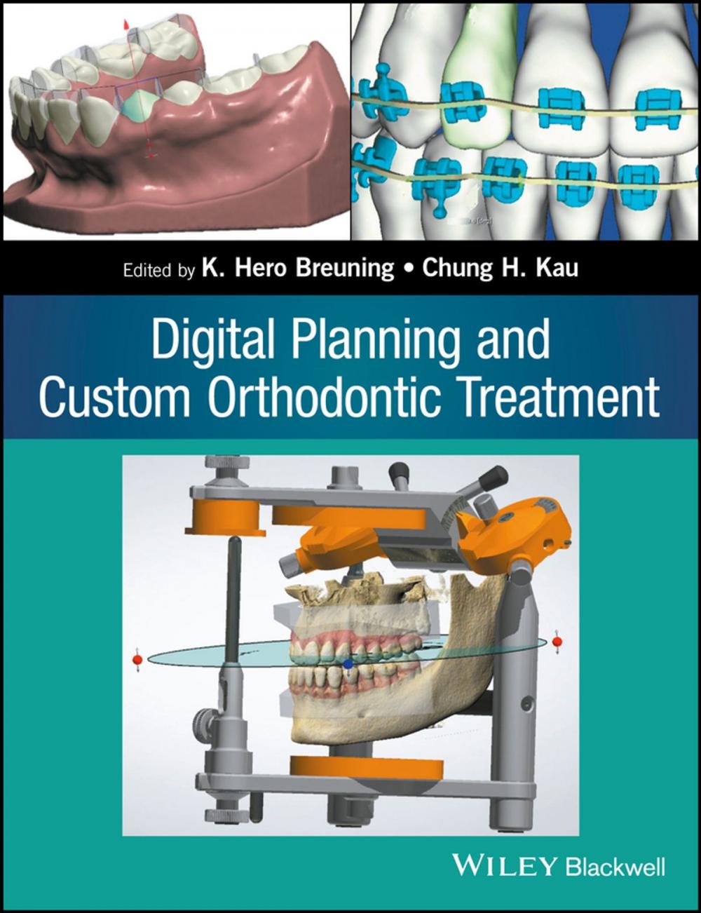 Big bigCover of Digital Planning and Custom Orthodontic Treatment