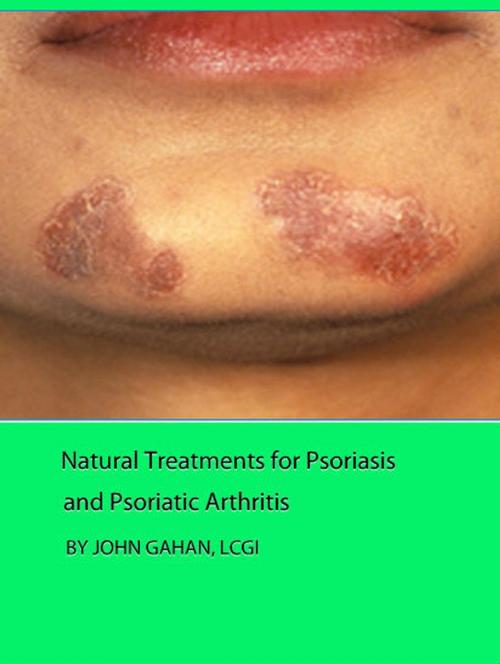 Cover of the book Natural Treatments for Psoriasis and Psoriatic Arthritis by John Gahan, LCGI, Sepharial