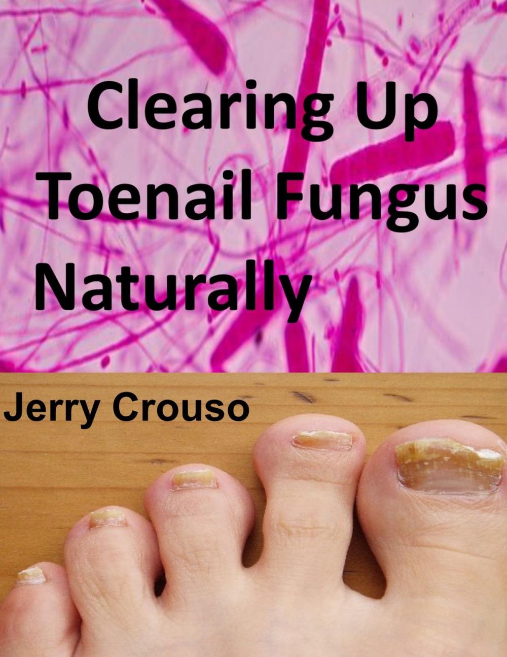 Big bigCover of Clearing Up Toenail Fungus Naturally